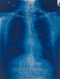 Chest X-ray
